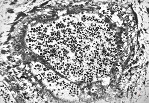 F, 24y. | molluscum contagiosum … virions